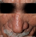 mycosis fungoides