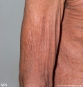 mycosis fungoides