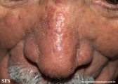 mycosis fungoides