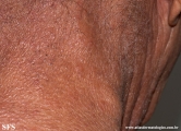 mycosis fungoides
