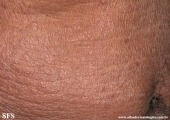 mycosis fungoides