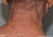 mycosis fungoides
