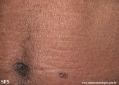 mycosis fungoides