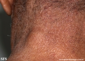mycosis fungoides