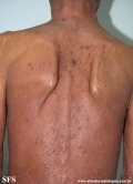 mycosis fungoides