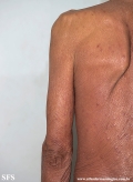 mycosis fungoides