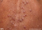 mycosis fungoides