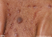 mycosis fungoides