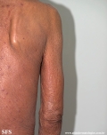 mycosis fungoides