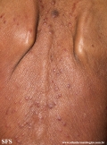 mycosis fungoides