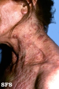 mycosis fungoides