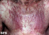mycosis fungoides
