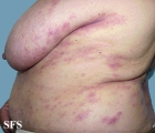 mycosis fungoides