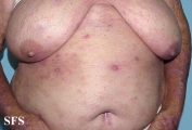 mycosis fungoides