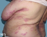 mycosis fungoides