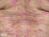 mycosis fungoides