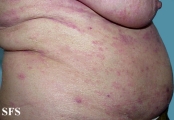 mycosis fungoides