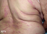 mycosis fungoides