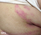 mycosis fungoides
