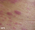 mycosis fungoides