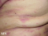 mycosis fungoides