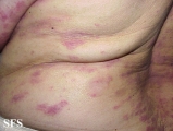 mycosis fungoides
