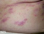 mycosis fungoides