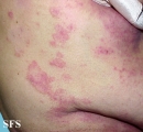 mycosis fungoides