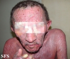 mycosis fungoides