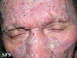 mycosis fungoides