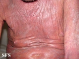 mycosis fungoides