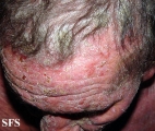 mycosis fungoides