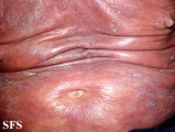 mycosis fungoides