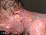 mycosis fungoides
