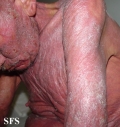 mycosis fungoides