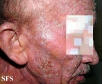 mycosis fungoides