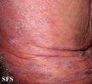 mycosis fungoides