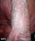 mycosis fungoides