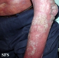 mycosis fungoides