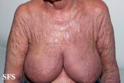 mycosis fungoides