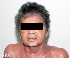 mycosis fungoides