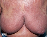 mycosis fungoides