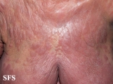 mycosis fungoides
