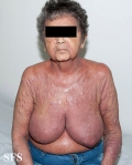 mycosis fungoides