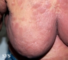 mycosis fungoides