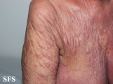 mycosis fungoides
