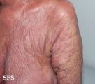 mycosis fungoides