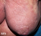 mycosis fungoides