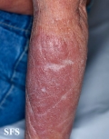 mycosis fungoides