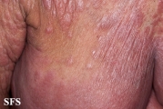 mycosis fungoides